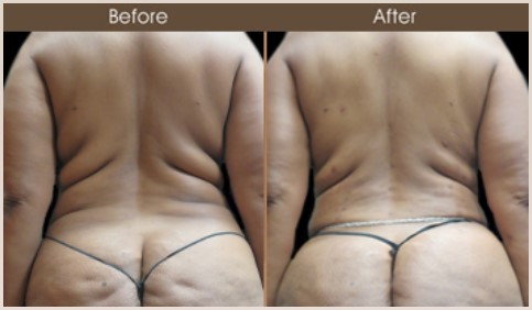 Gluteal Fat Grafting Before & After